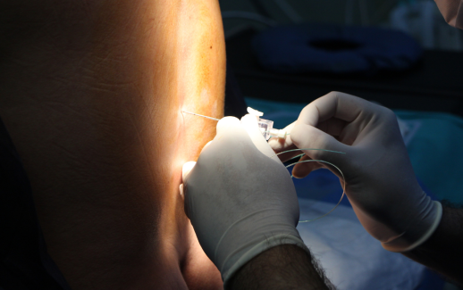 Epidural Pain Dr Jordan Sudberg